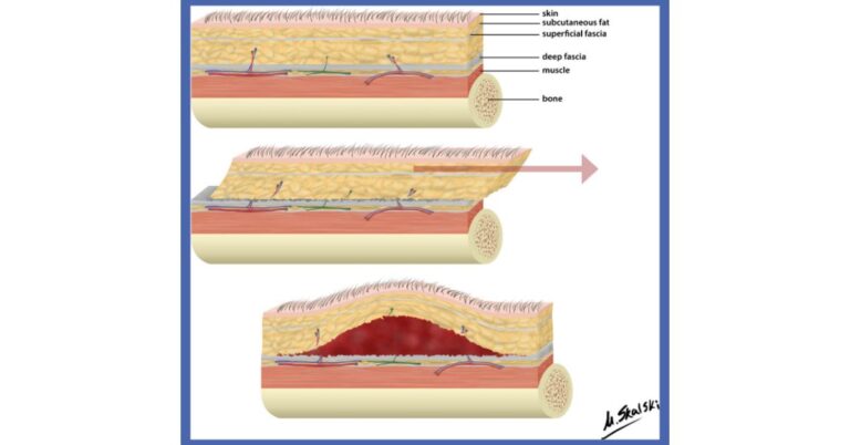 Difference between Morel Lavallee Lesion and Hematoma